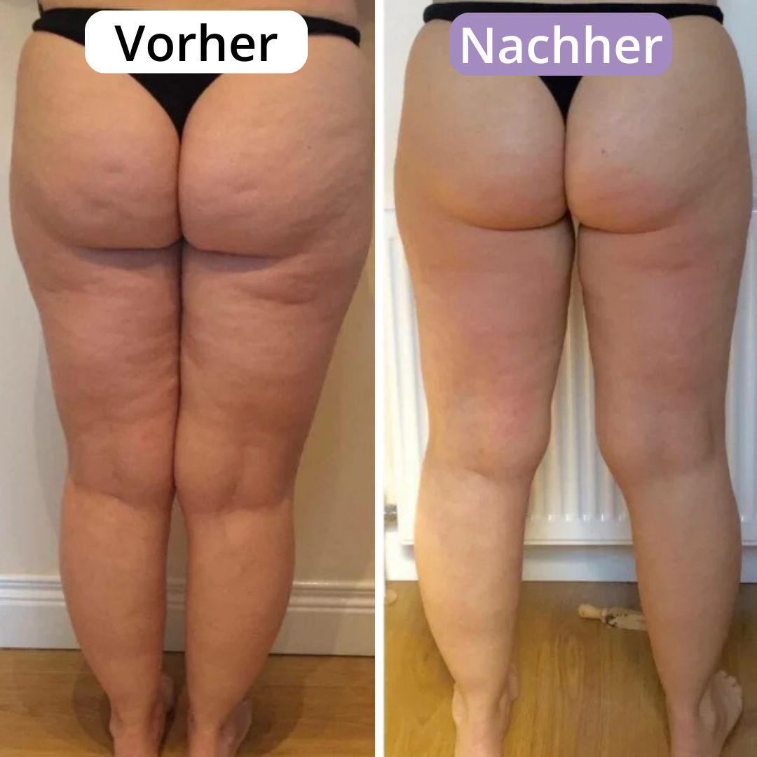 AveraSkin - Das Massagegerät gegen Cellulite