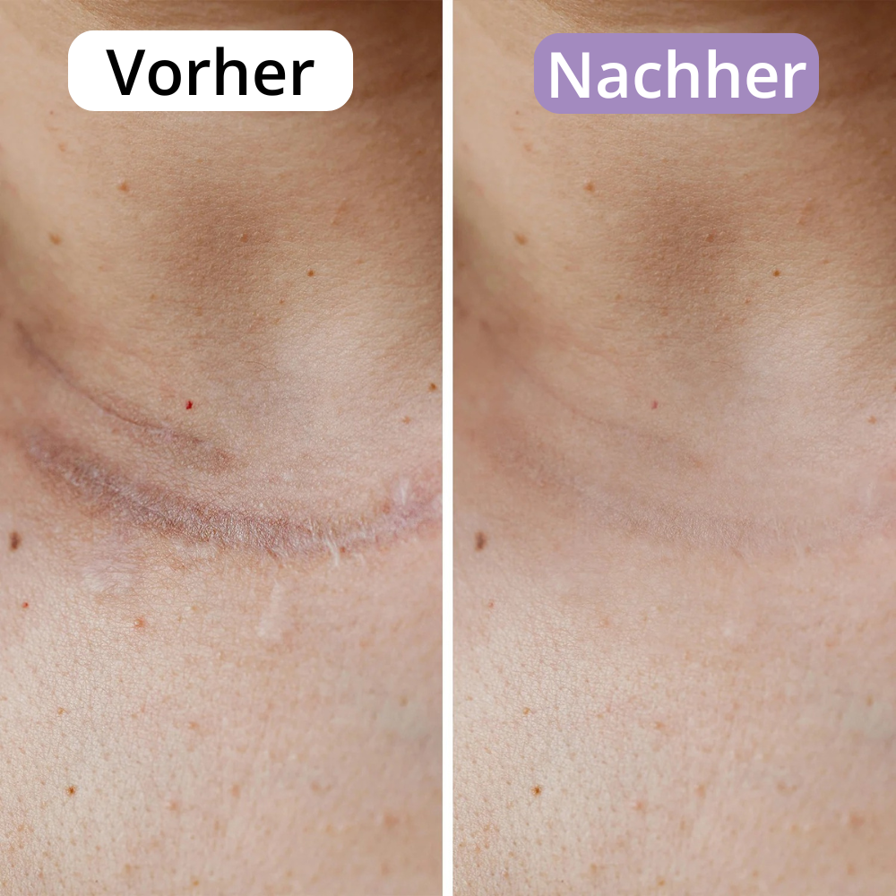 AveraSkin - Silikonpflaster gegen Narben und Falten