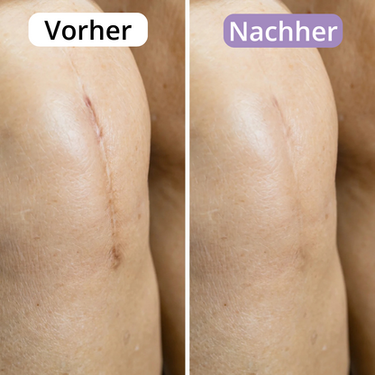 AveraSkin - Silikonpflaster gegen Narben und Falten