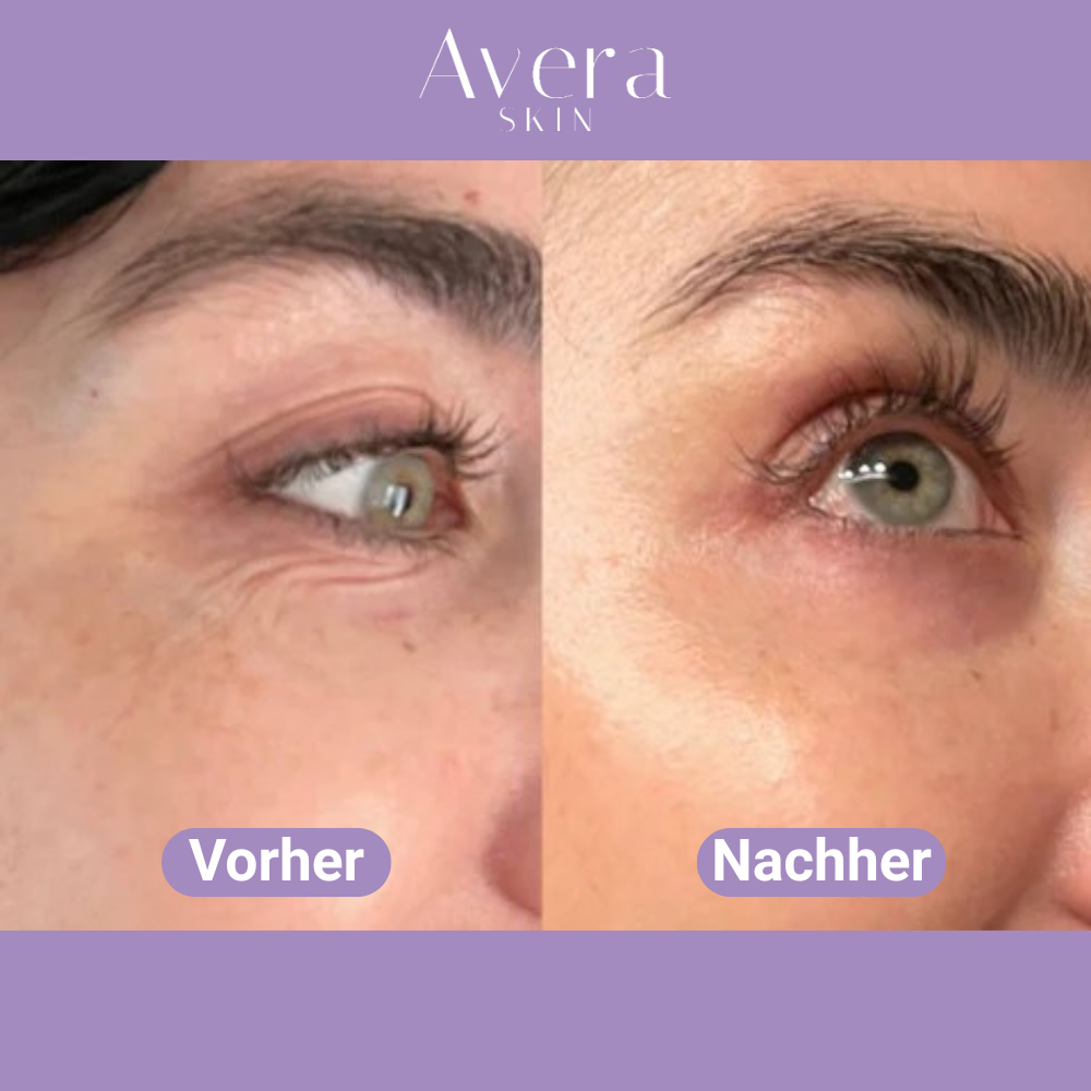 AveraSkin - Hyaluron Mikronadeln Augenpads